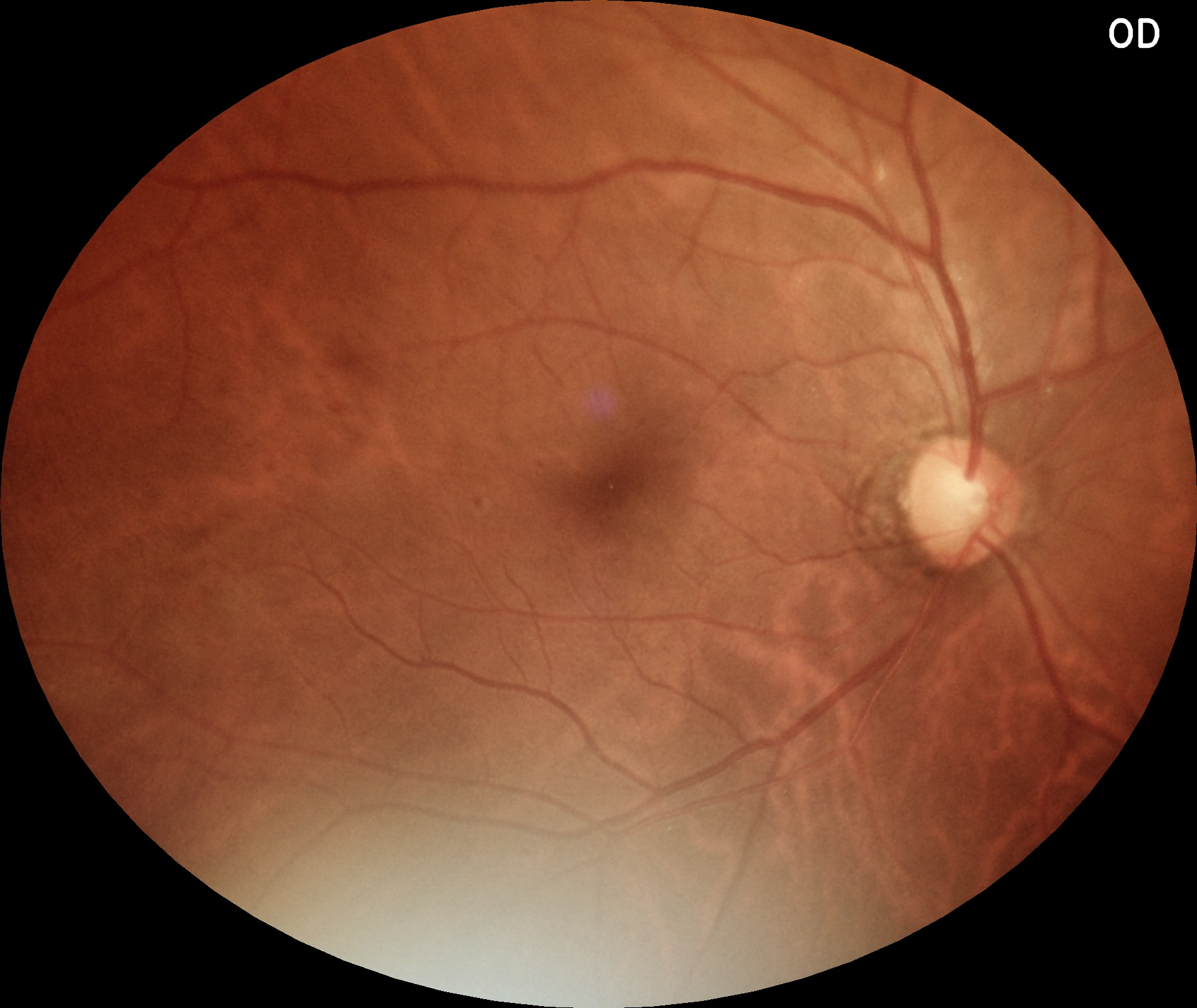 Right eye fundus image (OD)