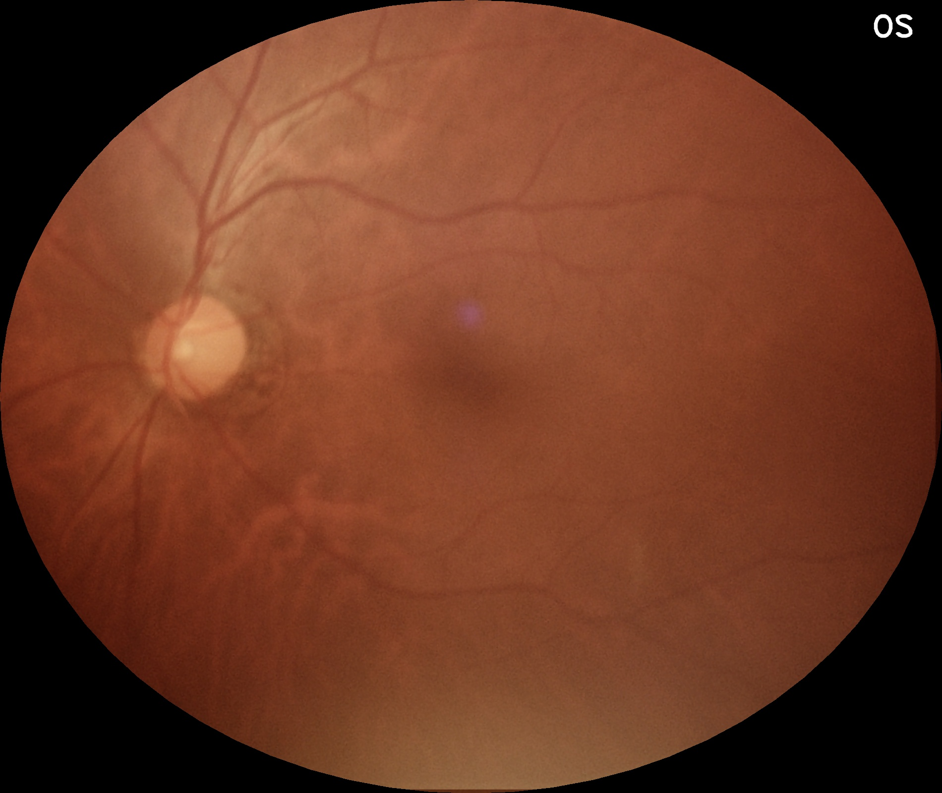 Left eye fundus image (OS)